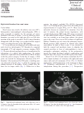 Cover page: Right atrial thrombus from renal cancer