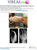 Cover page: Dorsally-Displaced Metacarpal Dislocation-Fracture
