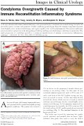 Cover page: Condyloma Overgrowth Caused by Immune Reconstitution Inflammatory Syndrome