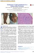 Cover page: Cutaneous T-Cell Lymphoma in a Patient With Psoriasis