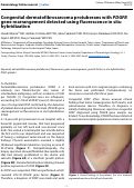 Cover page: Congenital dermatofibrosarcoma protuberans with PDGFB gene rearrangement detected using fluorescence in situ hybridization