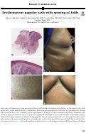 Cover page: Erythematous papular rash with sparing of folds
