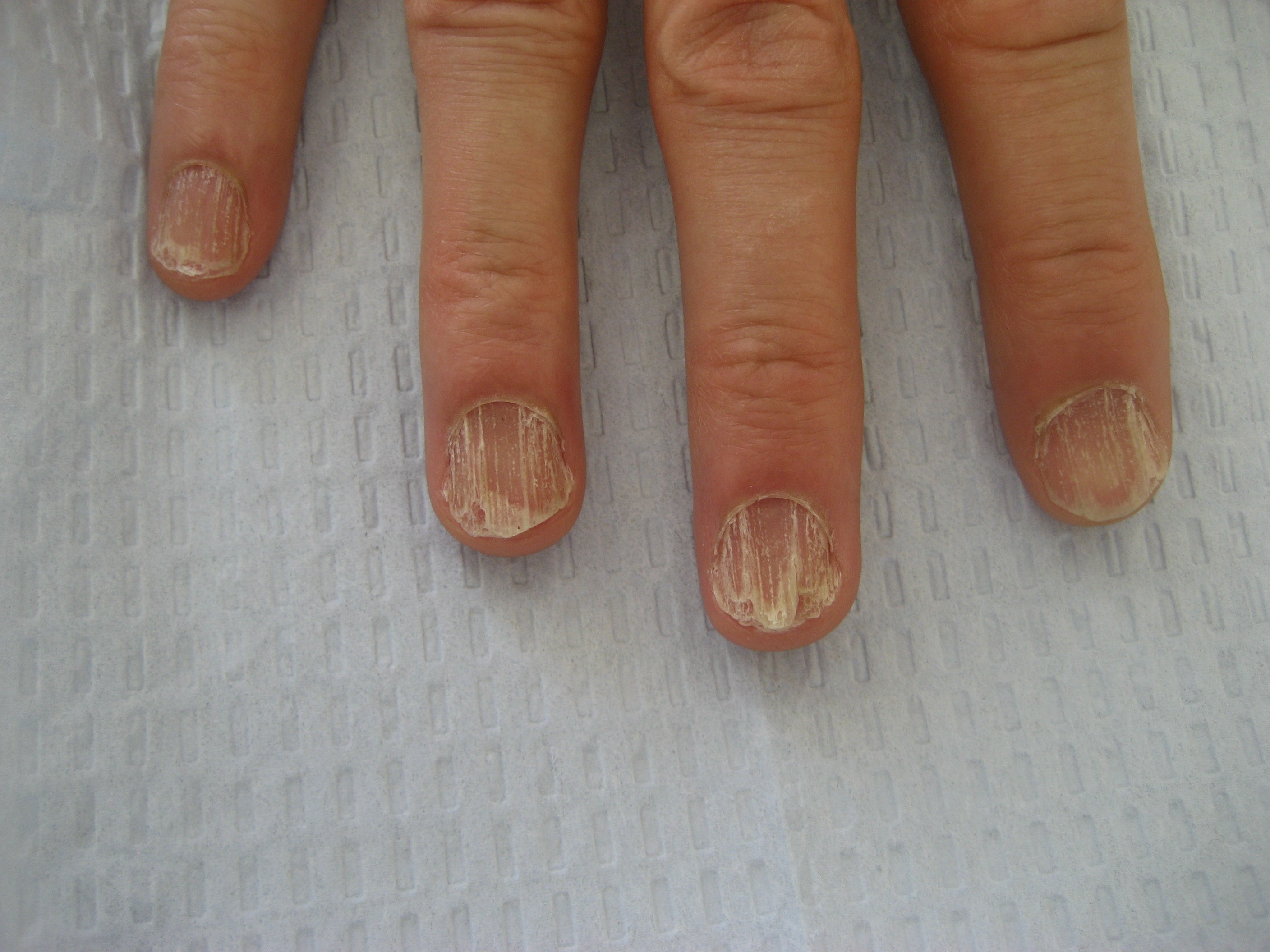 Common nail discoloration | First Derm