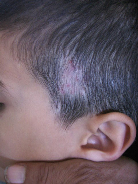 Case Of Kerion And Tinea Capitis In 9-Year-Old Boy