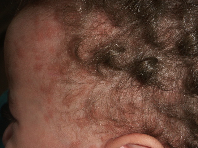 Tinea capitis in infants in their first 2 years of life: A 12-year study  and a review of the literature