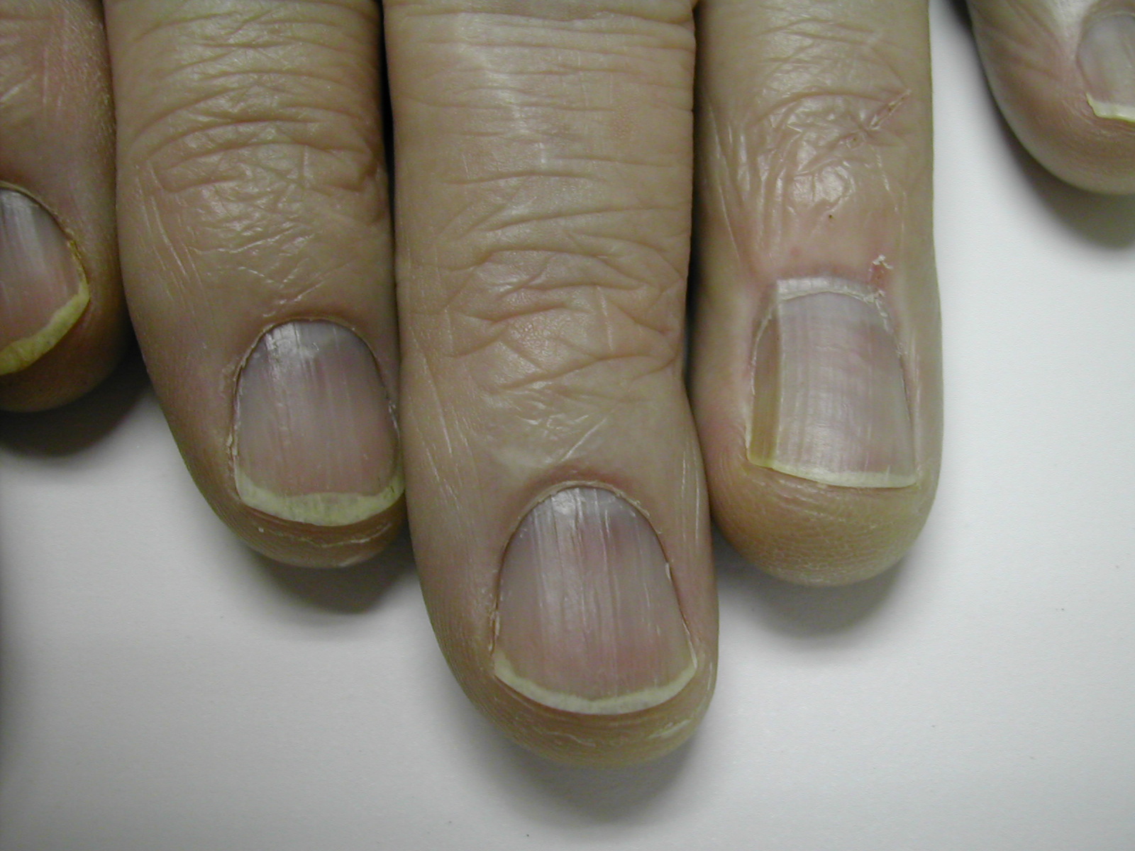 Nailfold Changes as a Sign of Underlying Systemic Illnesses
