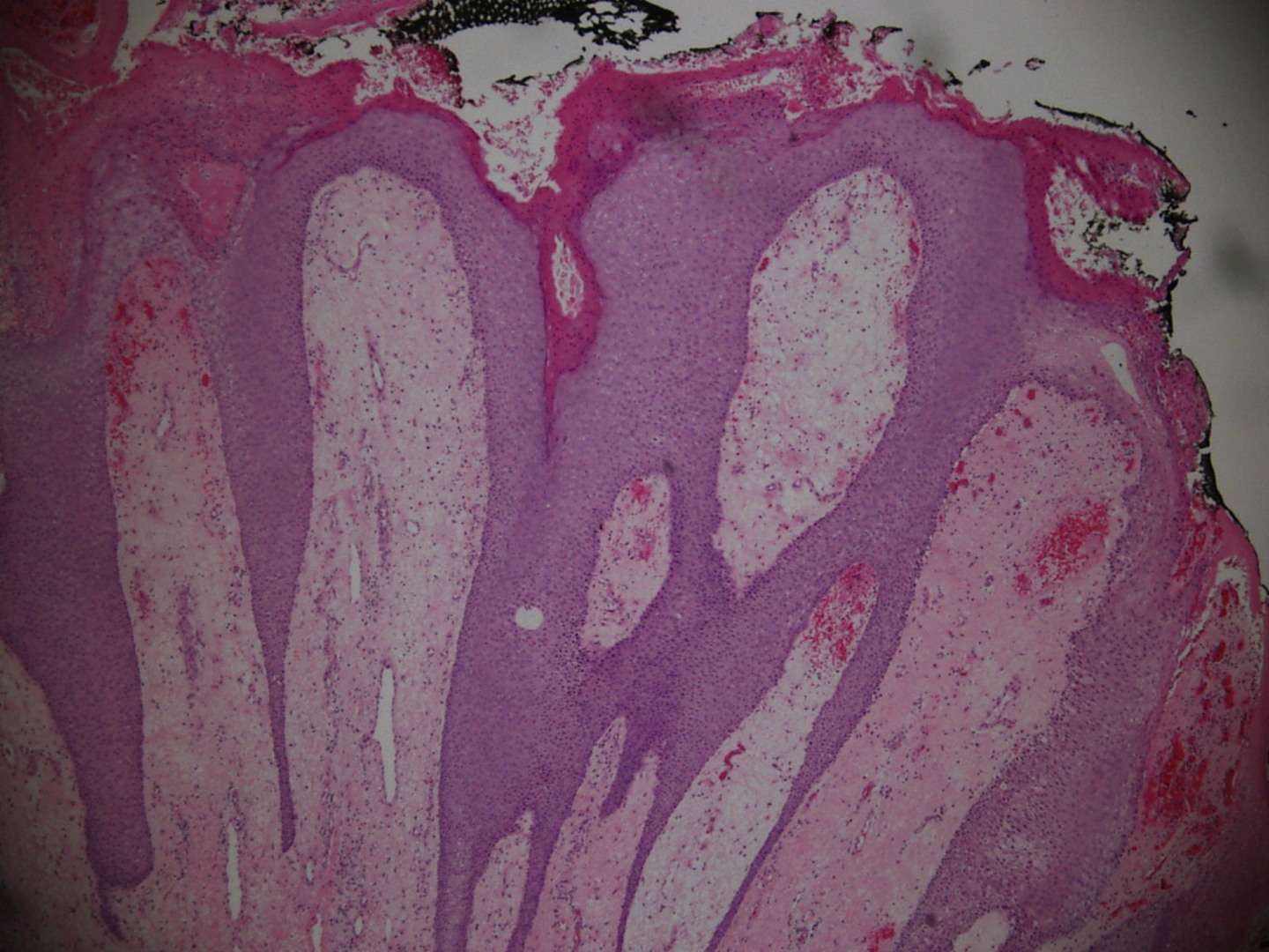 Elephantiasis Nostras Verrucosa On The Buttocks And Sacrum Of Two 