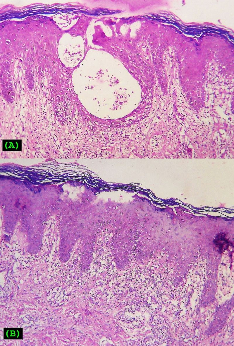 Docetaxel-induced supravenous serpentine dermatitis