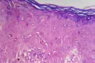 Docetaxel-induced supravenous serpentine dermatitis