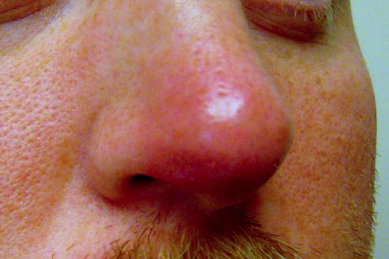 usikre Skærm ankomst The Rudolph sign of nasal vestibular furunculosis: Questions raised by this  common but under-recognized nasal mucocutaneous disorder