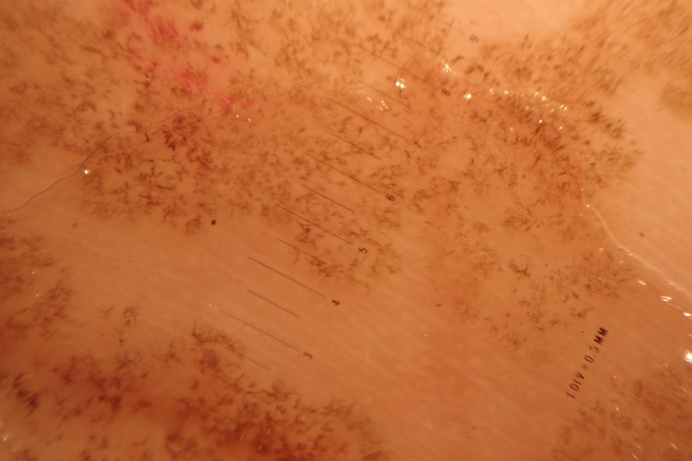 Papel da dermatoscopia na distinção entre tinea nigra e nevo