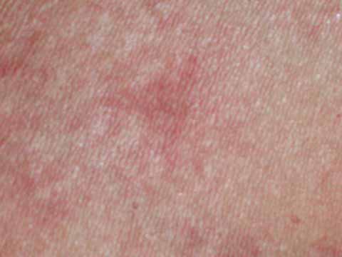 Telangiectasia Macularis Eruptiva Perstans Telangiectasia Macularis Eruptiva Perstans