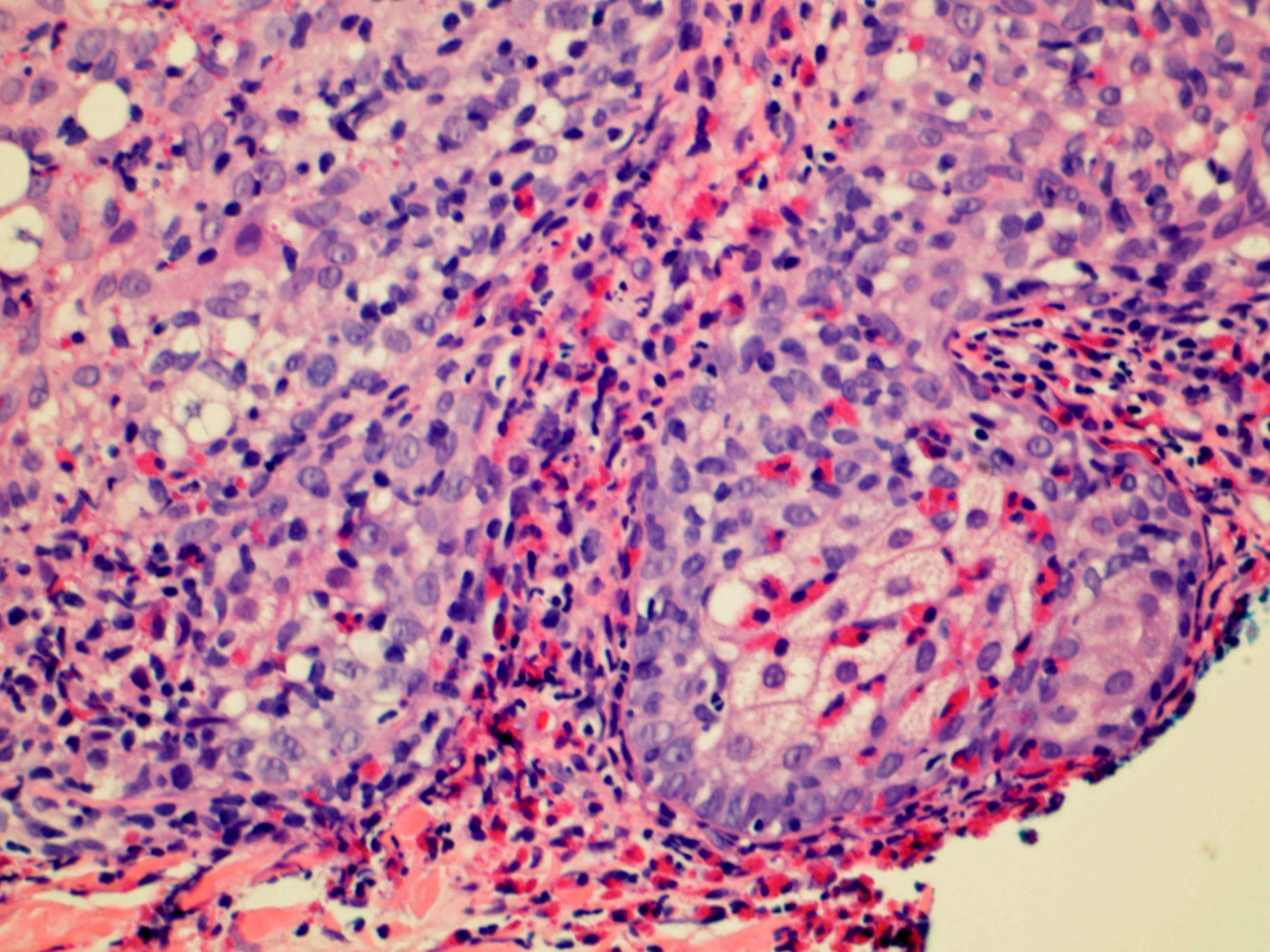eosinophilic pustular folliculitis histology