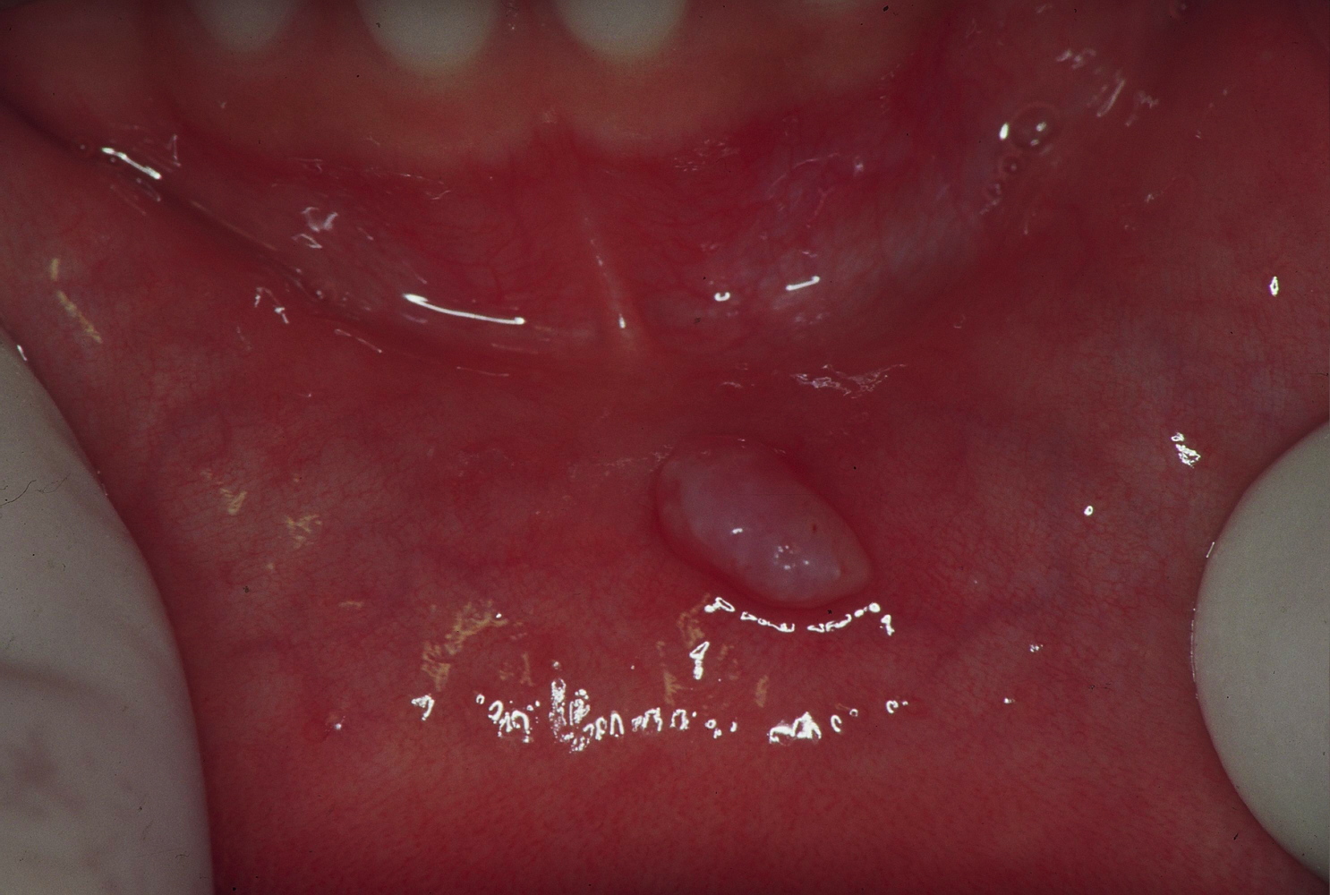 Oral Mucocele Burst At Benjamin Whitley Blog
