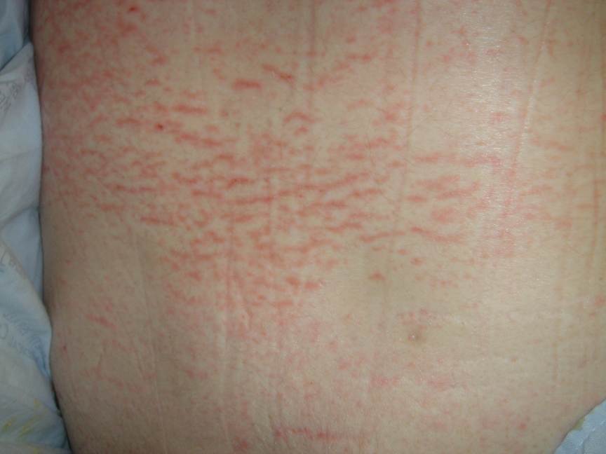 pinpoint red spots on the skin methotrexate