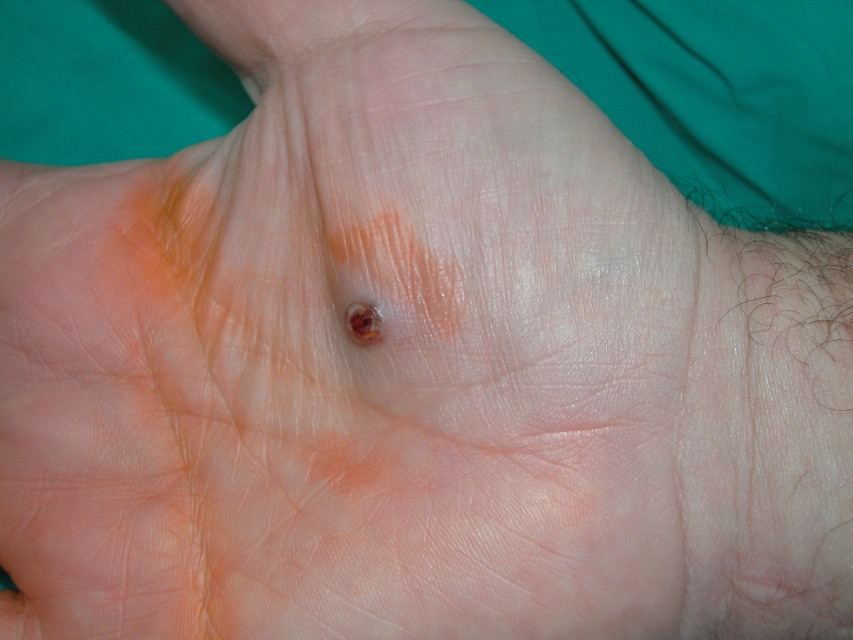 pyogenic granuloma finger