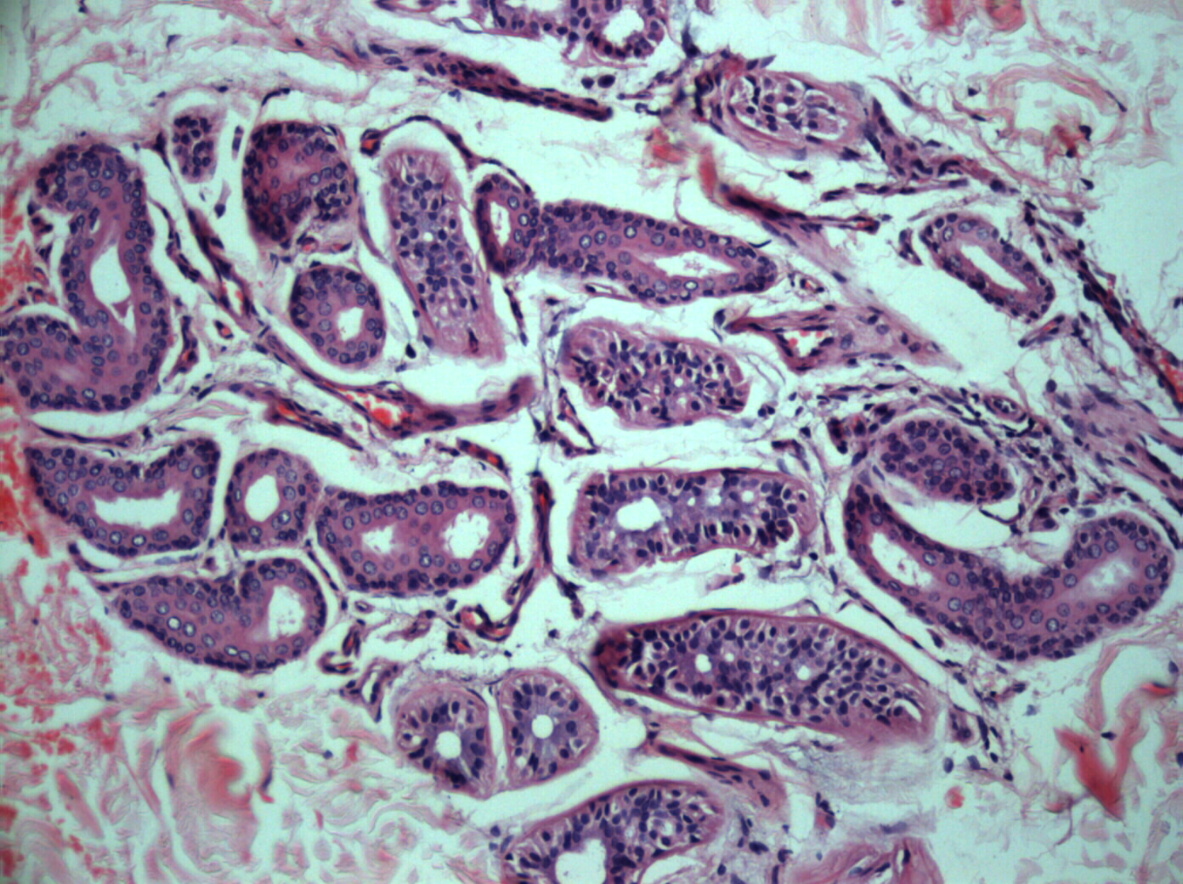 Adult onset eccrine angiomatous hamartoma