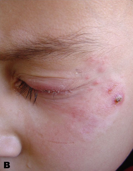 Periorbital psoriasis developing after trauma