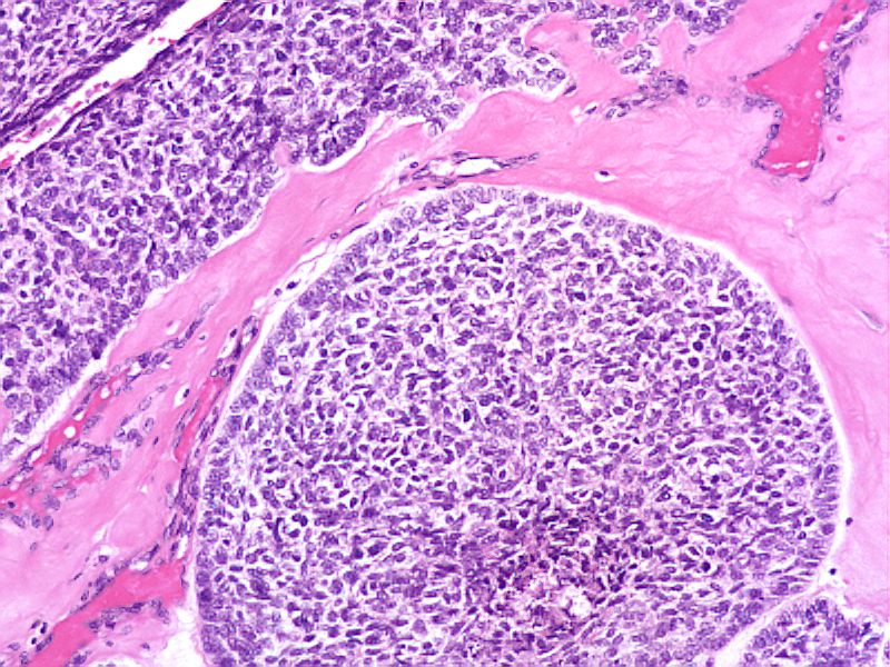 Metastatic Basal Cell Carcinoma A Case Report And Literature