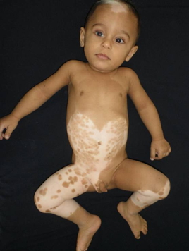waardenburg syndrome skin
