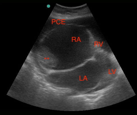  Subxiphoid view 