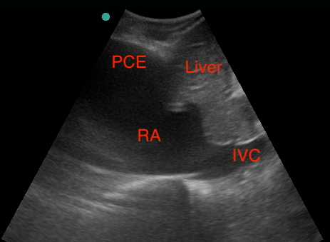  IVC 