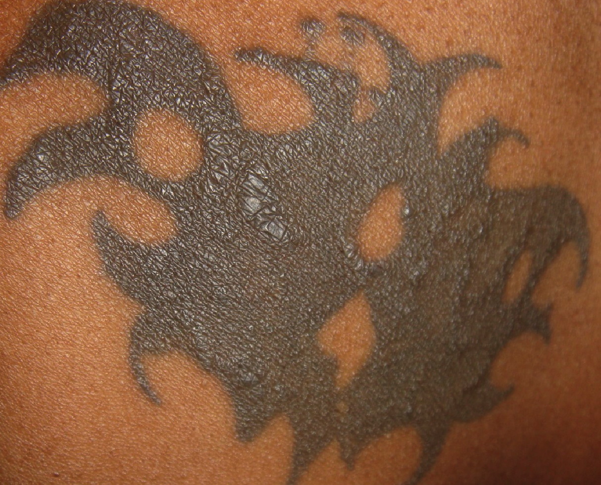 Sarcoidal tattoo granuloma