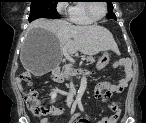 CT of the abdomen/pelvis