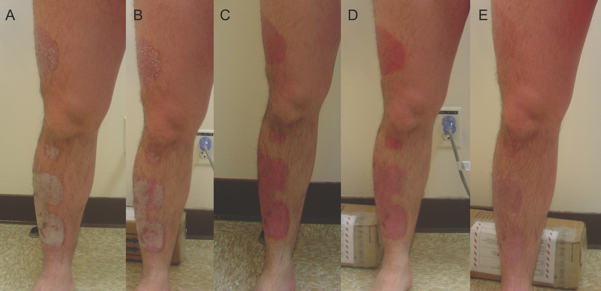before and after laser treatment for psoriasis