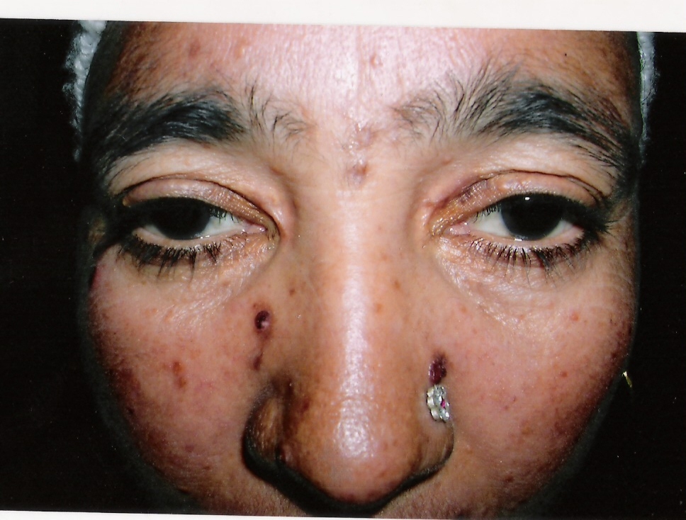 eruptive xanthomatosis face