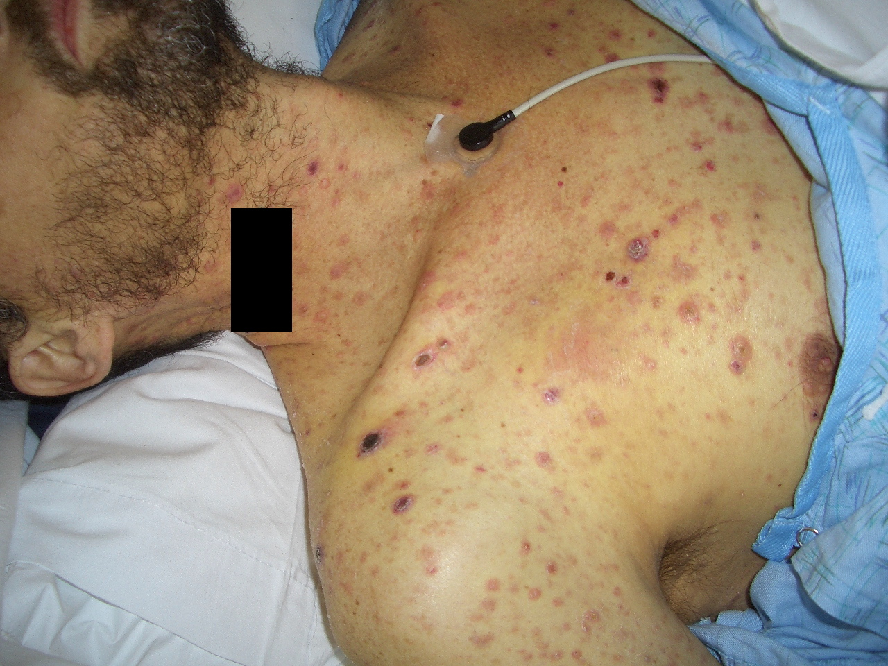 Fatal Alk Negative Systemic Anaplastic Large Cell Lymphoma Presenting With Disseminated Cutaneous Dome Shaped Papules And Nodules