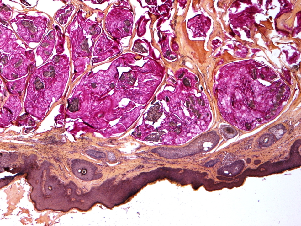 Report Of A Case Primary Mucinous Carcinoma Of The Skin
