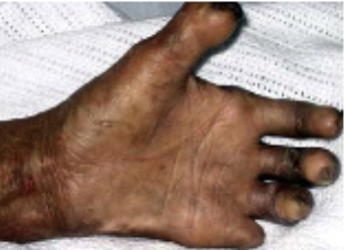 tuberculoid leprosy symptoms