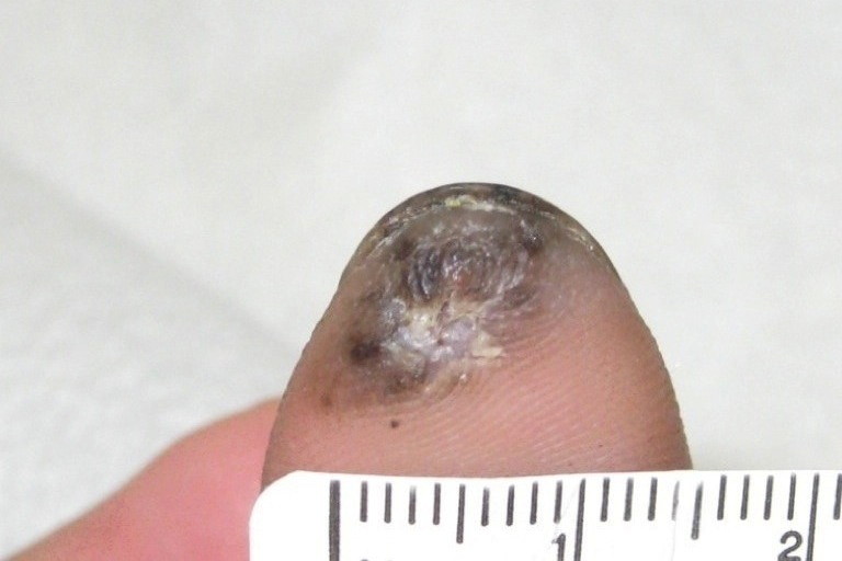 Best Clinic for Nail Tumor Treatment In Bangalore | Nail Tumor Treatment