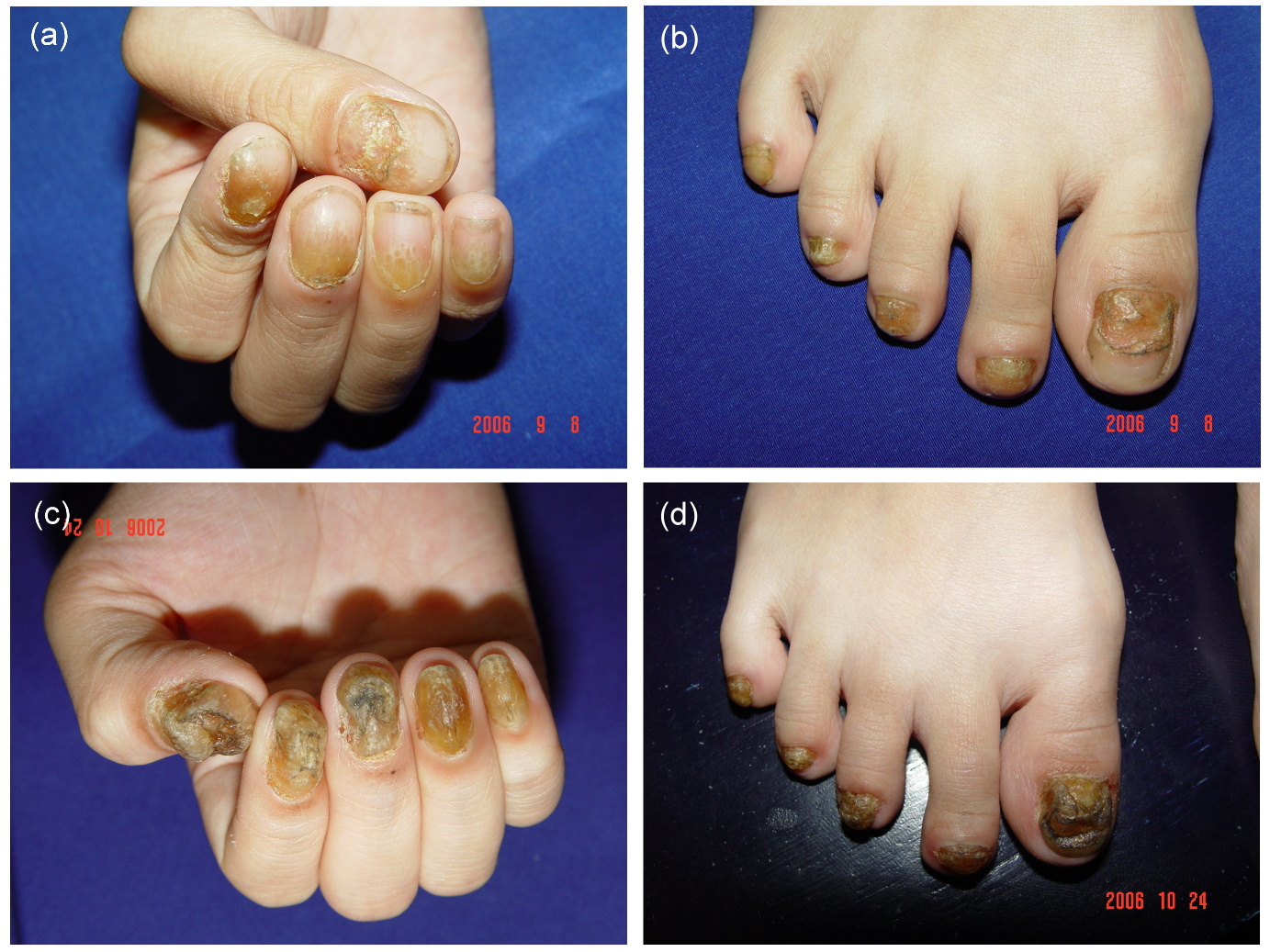 Top more than 101 20 nail dystrophy lichen planus latest - noithatsi.vn