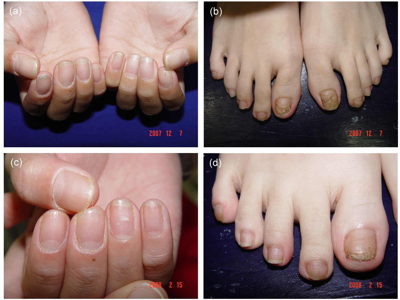 SKIN & Aesthetics Center - A case of 20 nail dystrophy treated with steroid  injection. | Facebook