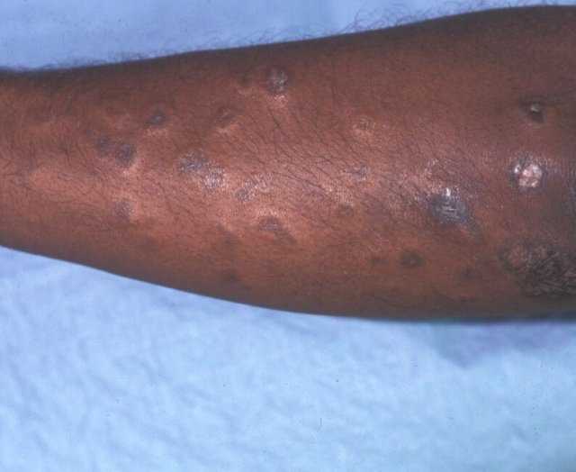 Papulonodular mucinosis in systemic lupus erythematosus
