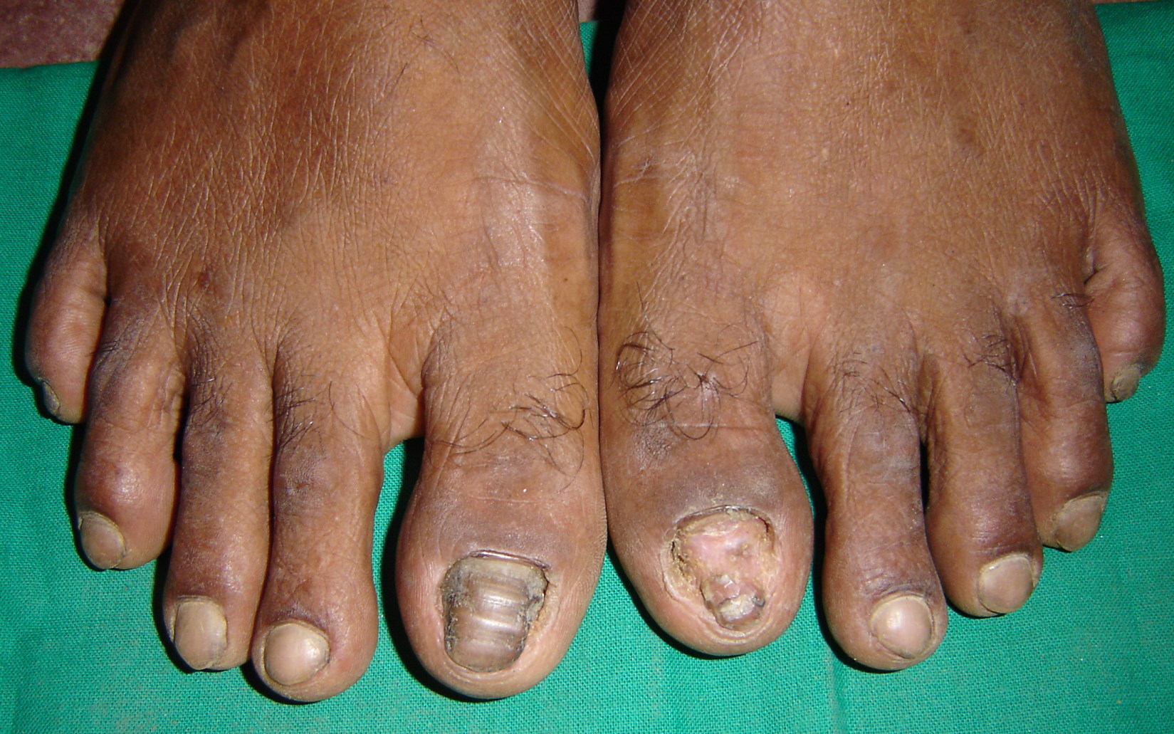 White Superficial Onychomycosis