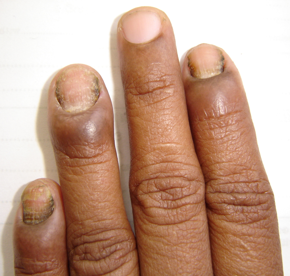 Nails, Skin, and Callus Treatment | Wound Specialist Physician | DeLand