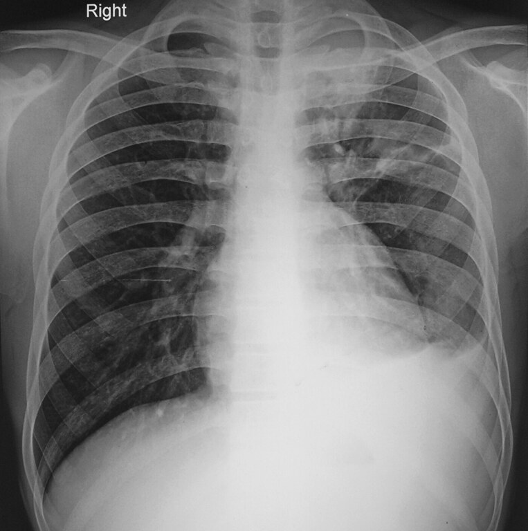 Non-healing Perianal Ulcer: A Rare Presentation Of Cutaneous Tuberculosis