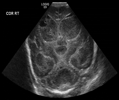  Coronal head ultrasound 