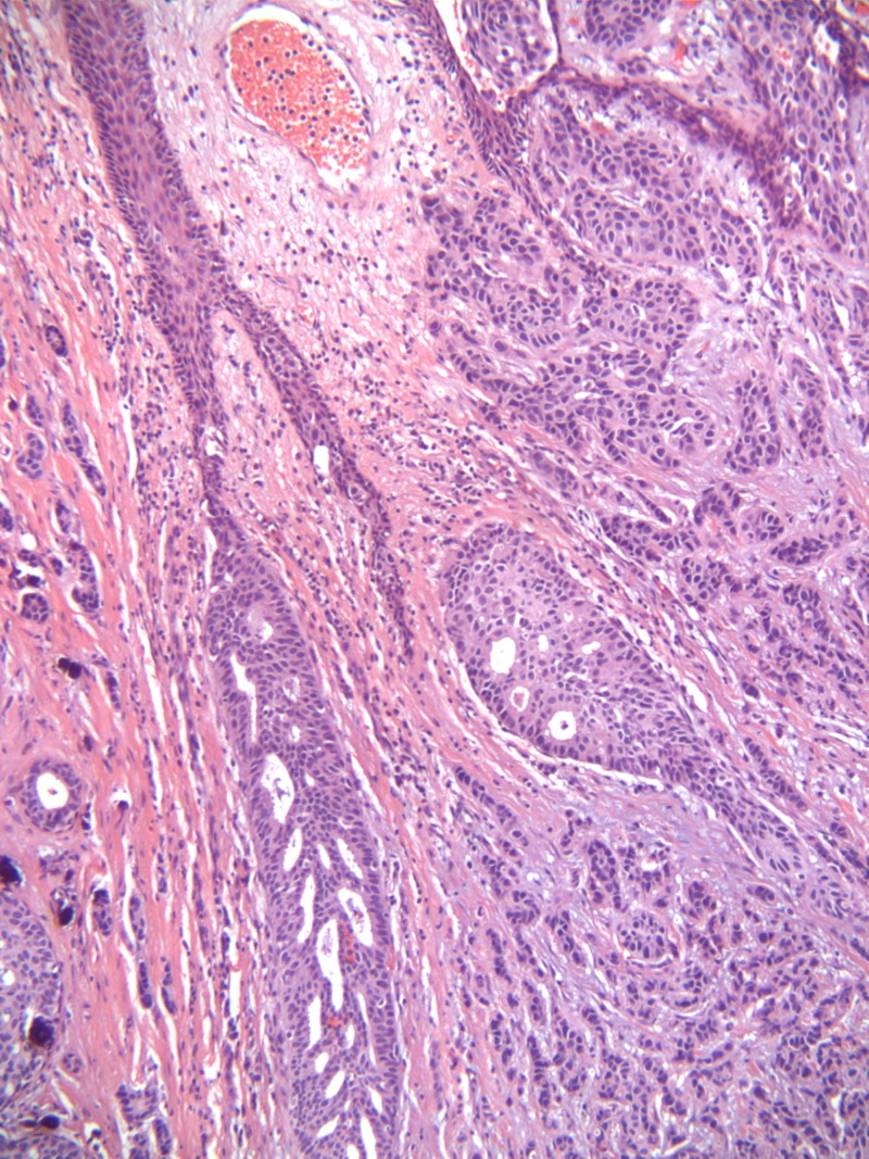 Invasive primary ductal apocrine adenocarcinoma of axilla: A case ...