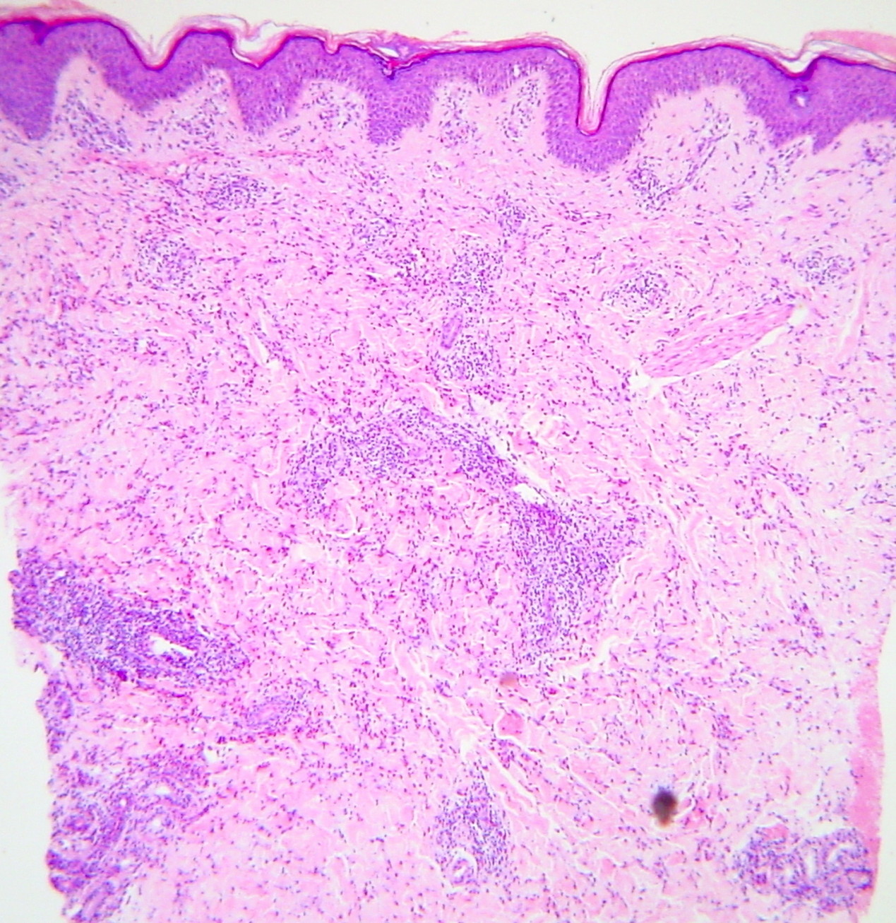 Eosinophilic annular erythema