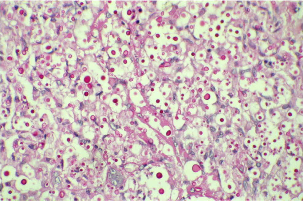 Cutaneous cryptococcosis of the penis