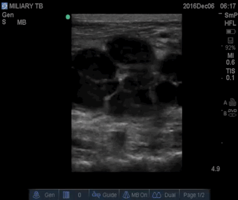  Long axis view of the left lateral neck with the high frequency transducer. 