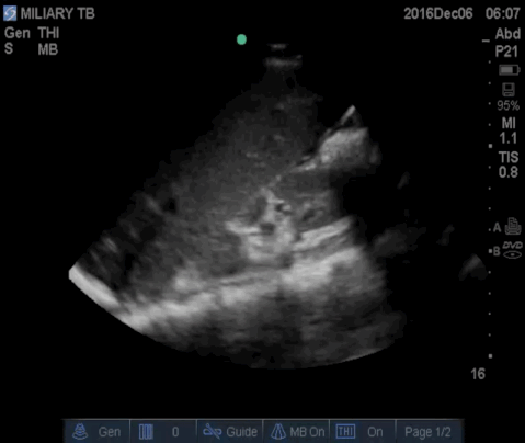  Right upper quadrant of the abdomen demonstrating trace fluid in the hepatorenal recess. 
