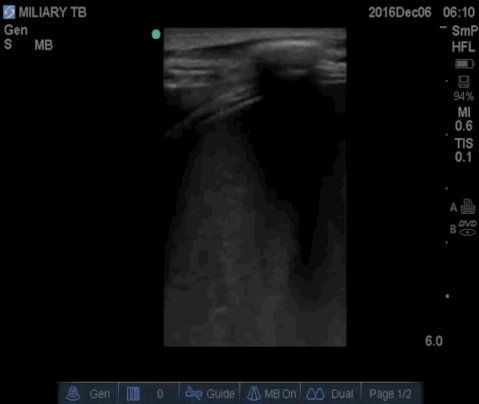  Linear high frequency video of the spleen used to rule out microabscesses. 