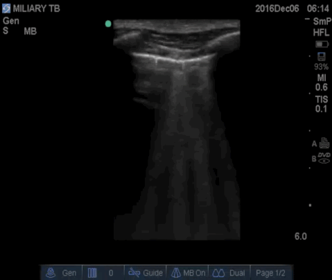  Long axis view of the lung with the high frequency linear array. 