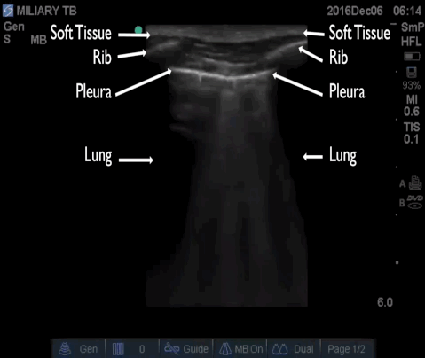  Annotated long axis image of the lung with the high frequency linear array. 
