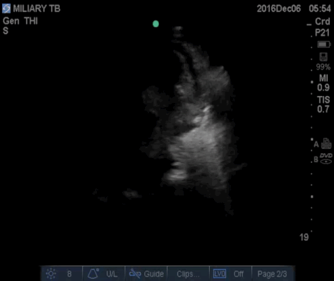  Apical 4 chamber view demonstrating a small pericardial effusion.